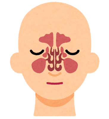副鼻腔炎の断面図